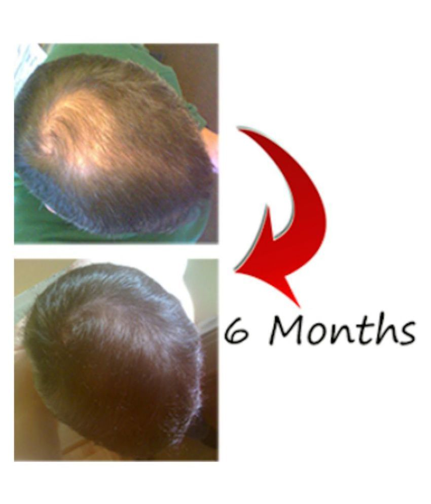 Lipogaine For Men Intensive Treatment Complete Solution For