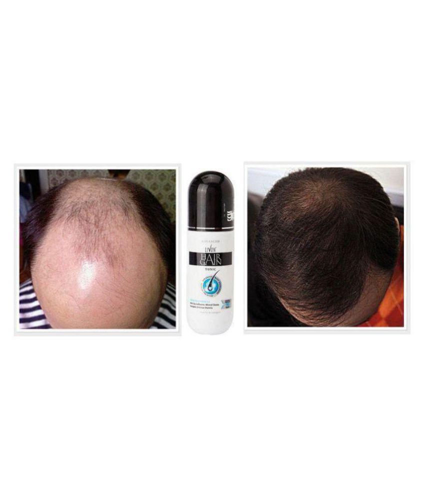 Livon Hair Gain 150ml Tonic: Buy Livon Hair Gain 150ml Tonic at Best Prices in India - Snapdeal Livon Hair Gain 150ml Tonic: Buy Livon Hair Gain 150ml Tonic at Best Prices in India - Snapdeal