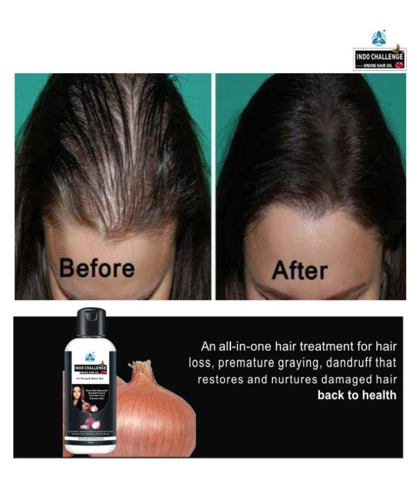 INDO CHALLENGE Onion Regrowth Oil For Hair Therapy 100 mL: Buy INDO CHALLENGE Onion Regrowth Oil For Hair Therapy 100 mL at Best Prices in India - Snapdeal INDO CHALLENGE Onion Regrowth Oil For Hair Therapy 100 mL: Buy INDO CHALLENGE Onion Regrowth Oil For Hair Therapy 100 mL at Best Prices in India - Snapdeal